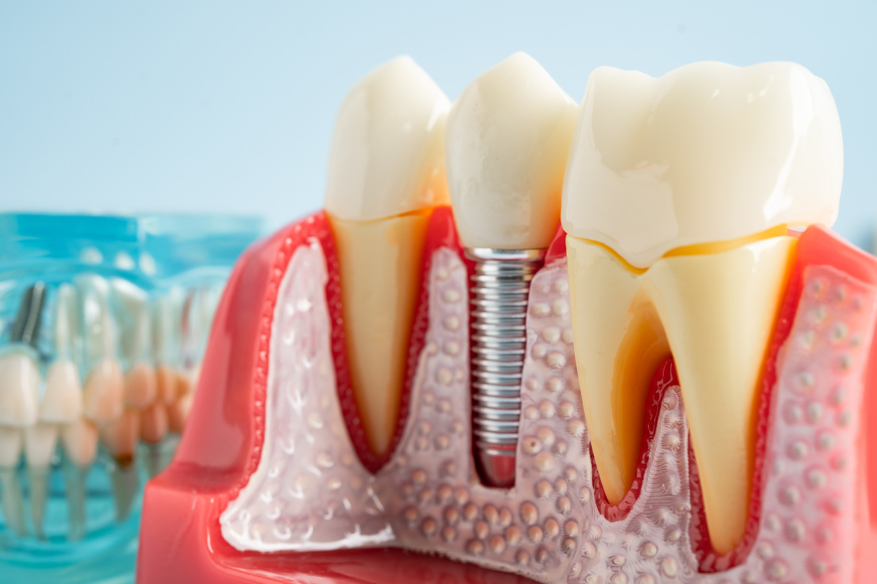 rodzaje implantów zębowych, dentysta w gdańsku